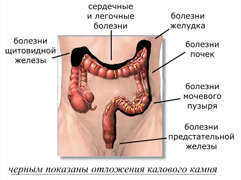 Строение кишечника, очистка организма, зашлакованный толстый кишечник, желудочно-кишечный тракт, кал